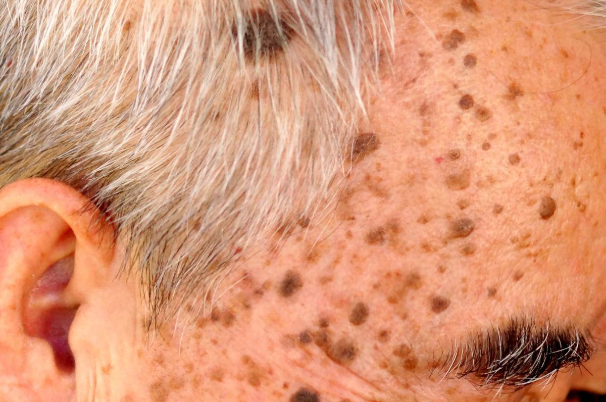 Understanding Common Benign Skin Growths Dr Hm Liew Skin Clinic