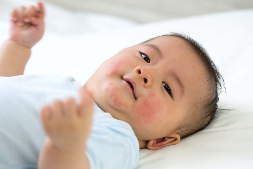 FAQ With Dr Liew: “What Causes Pregnancy Rashes and How to Treat