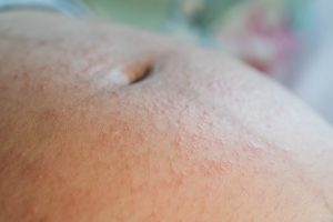 Could this be pregnanancy hives?